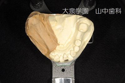 人工歯排列