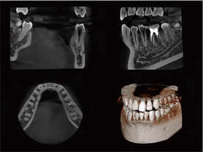 歯科用３D－CT