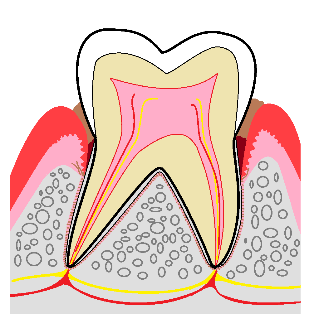 中程度の歯周炎